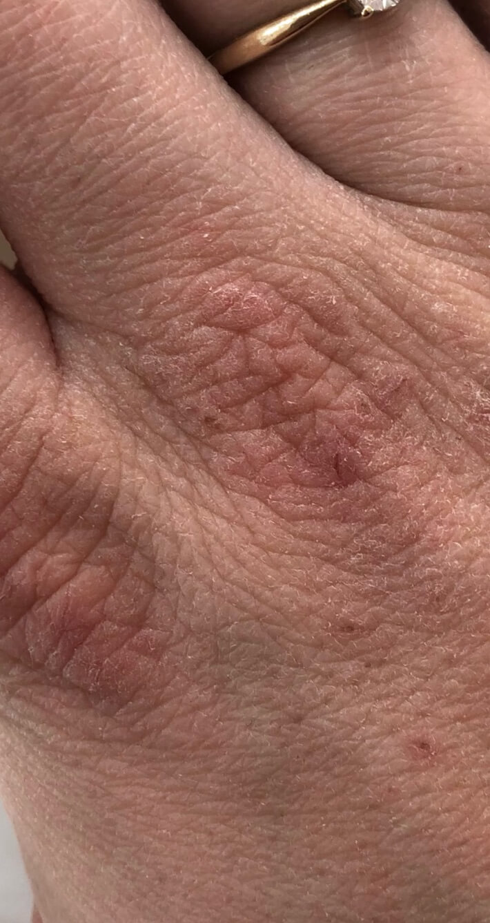 Pierwszy dzień kuracji