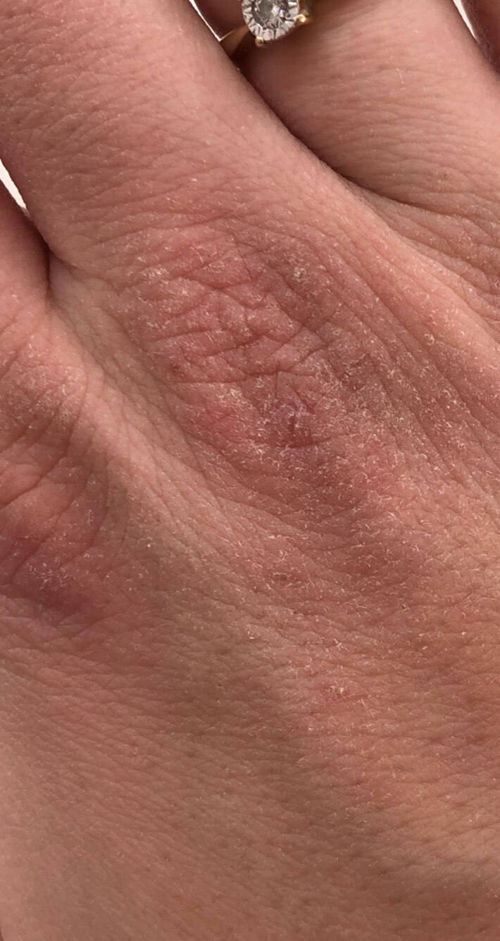 Drugi dzień kuracji