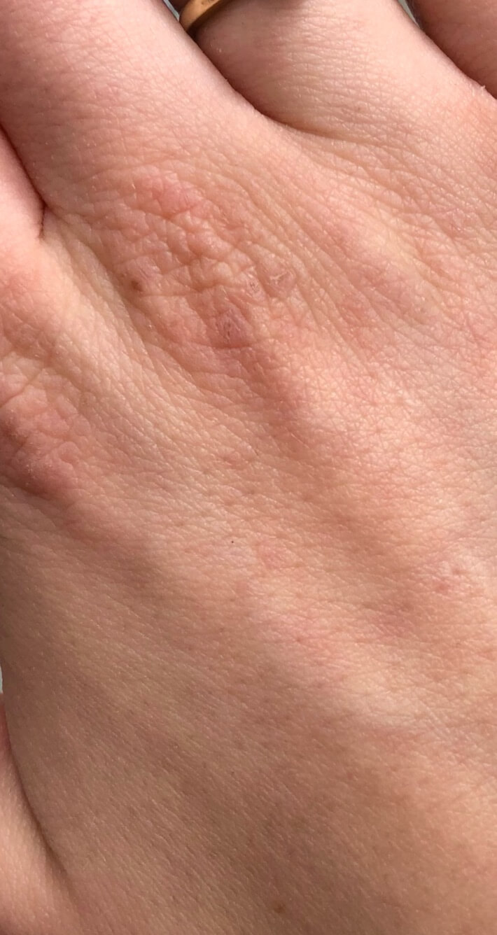 Trzeci dzień kuracji